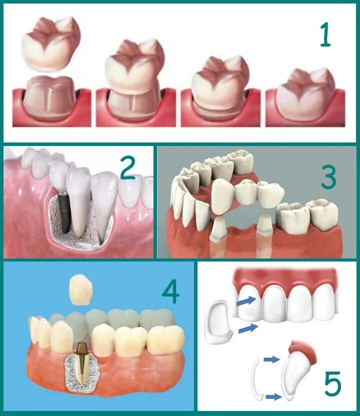 Микропротезы виниры вкладки стоматология. Стоматологические коронки. Стоматологические коронки на зубы.