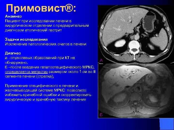 Образования печени кт. Мрт печени с примовистом. Образования печени мрт. Объемные образования печени на мрт.