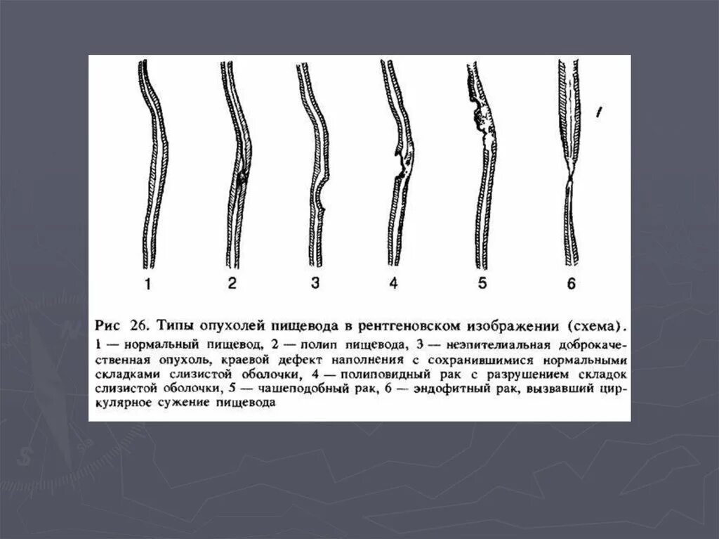 Пищевод складки слизистой. Физиологические сужения пищевода рентген. Анатомия пищевода рентген. Рентгеноанатомия пищевода. Рентгеноанатомия пищевода схема.