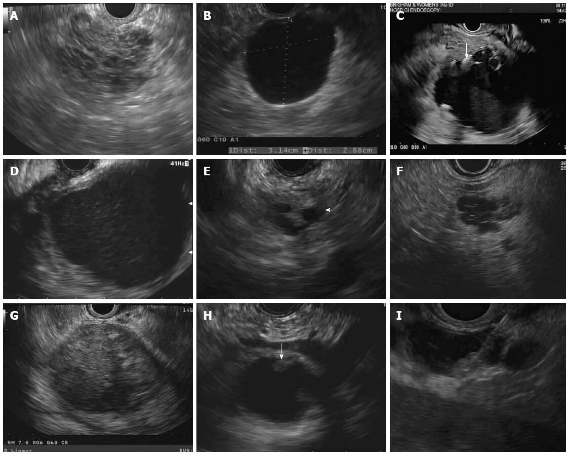 Матка 31 мм. IPMN поджелудочной железы. Endoscopic Ultrosound for serous cystoadenoma pancreas.