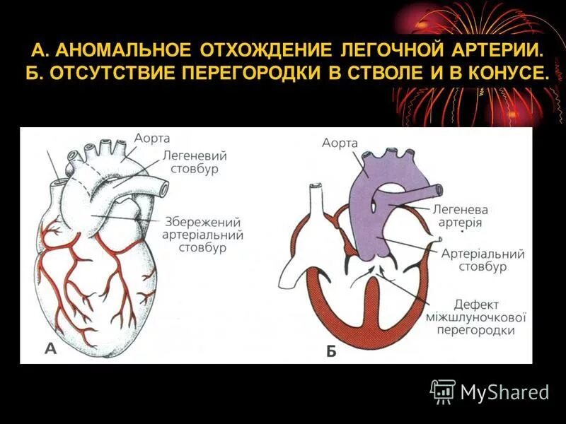 Только правая дуга аорты. Сегменты легочной артерии. Впс общий артериальный ствол. Бронхиальные ветви грудной аорты анатомия. Строение сердца с отходящими сосудами.