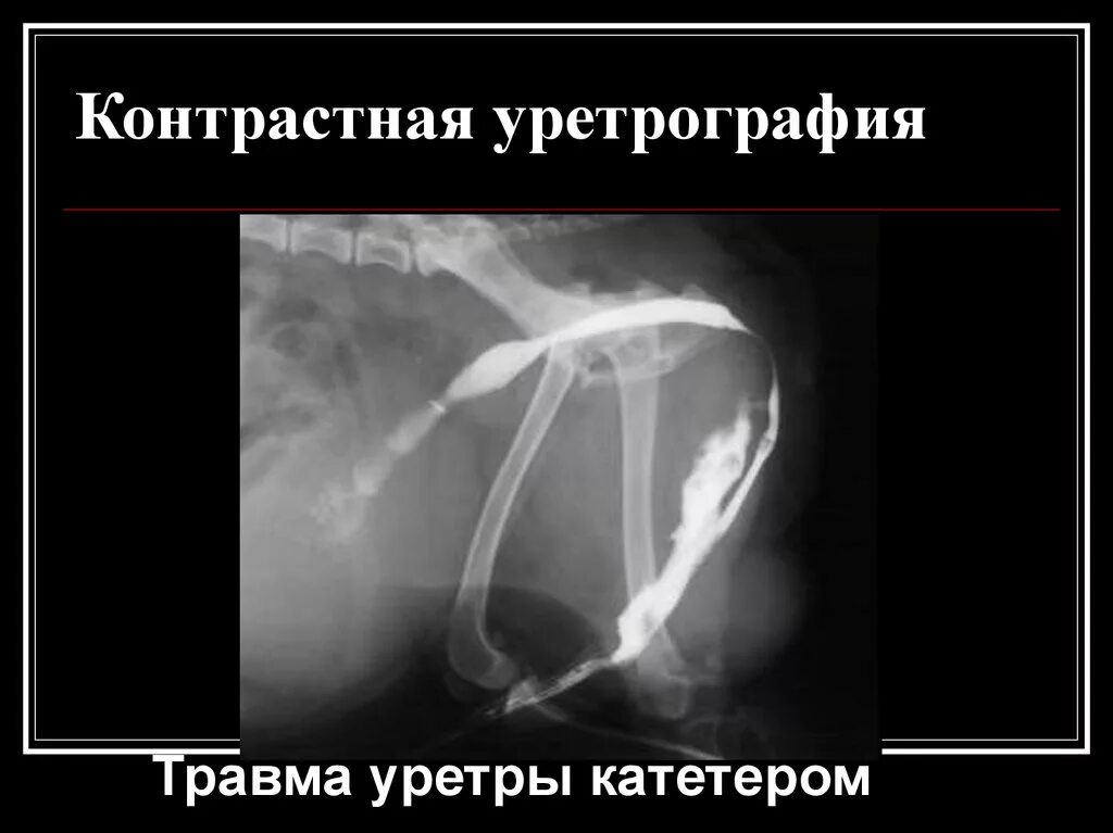 Рентген уретры. Стриктура уретры уретрография. Стриктура уретры у мужчин рентген. Рентген анатомия уретры. Стриктура уретры уретрография.