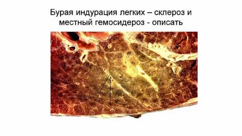 Бурая индурация легких