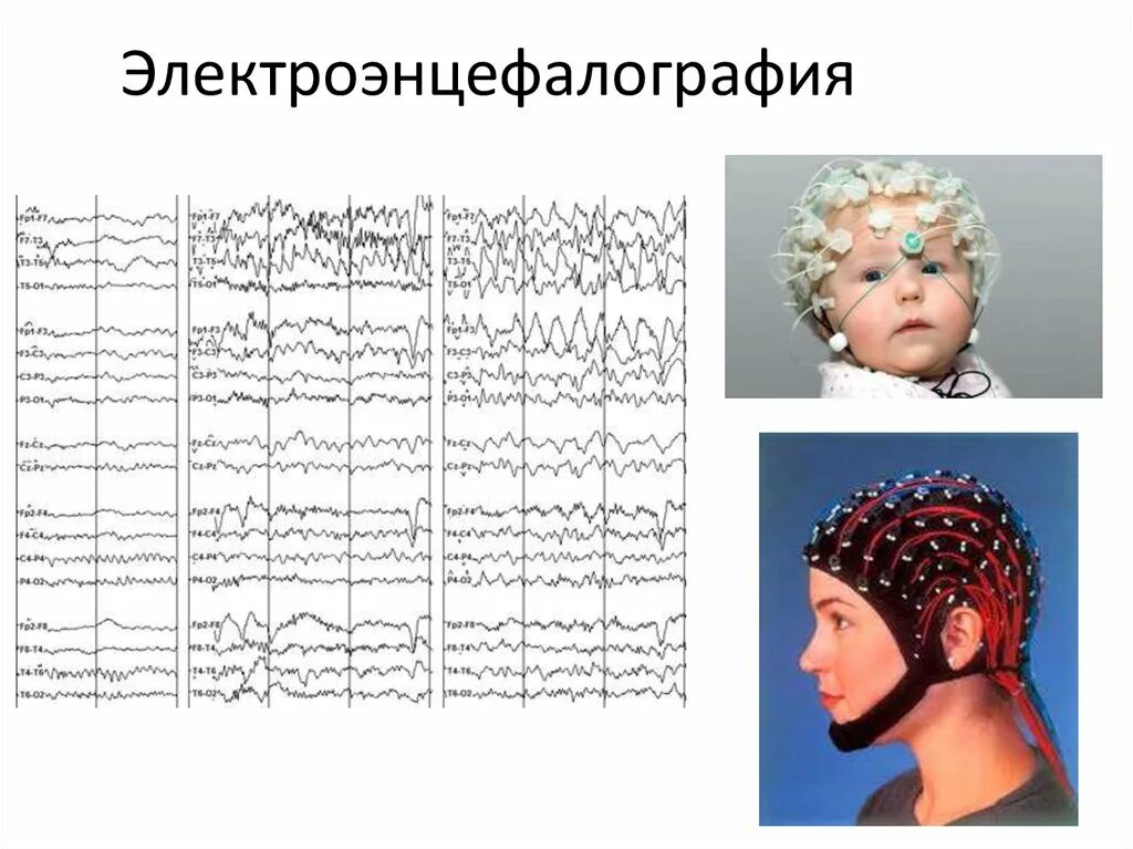 Ээг ребенку пермь. Электроэнцефалография. ээг. метод электроэнцефалографии. ээг человека.