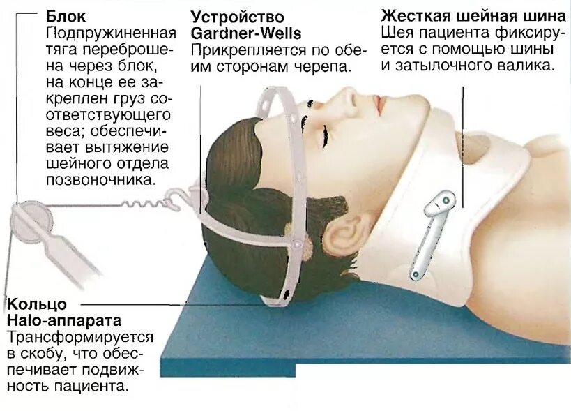 Компрессионный перелом позвоночника скелетное вытяжение. Перелом шейных позвонков. Передом шейный позвонков. При переломе шейного отдела позвоночника. Шейная грыжа операция отзывы