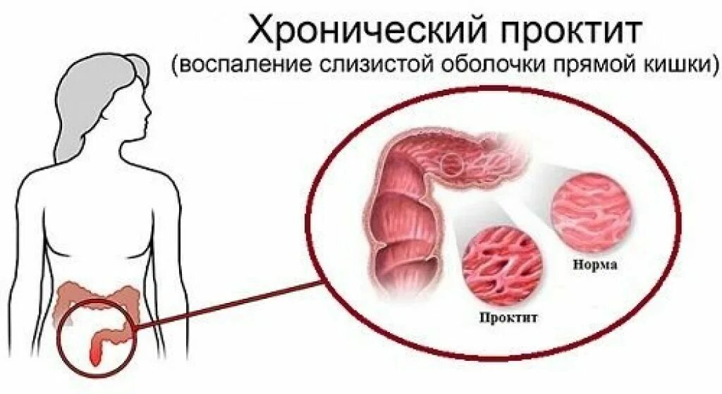 Воспаление прямой кишки. Воспаление прямой кишки (проктит). Воспаление прямого кишечника. Лечение проктита прямой