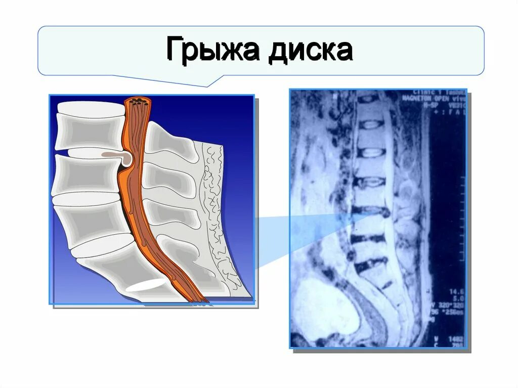 Признаки грыжа диска