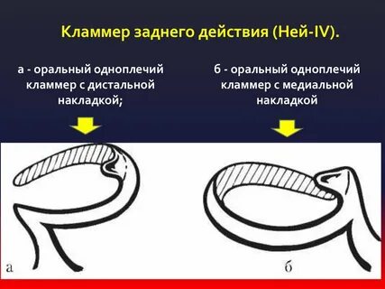 Кламмер медицина