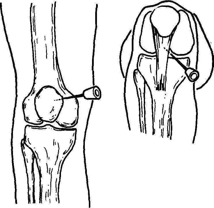 Точки пункции коленного сустава. Пункция коленного сустава техника точки. Внутрисуставные инъекции в коленный сустав. Пунктирование тазобедренного сустава.