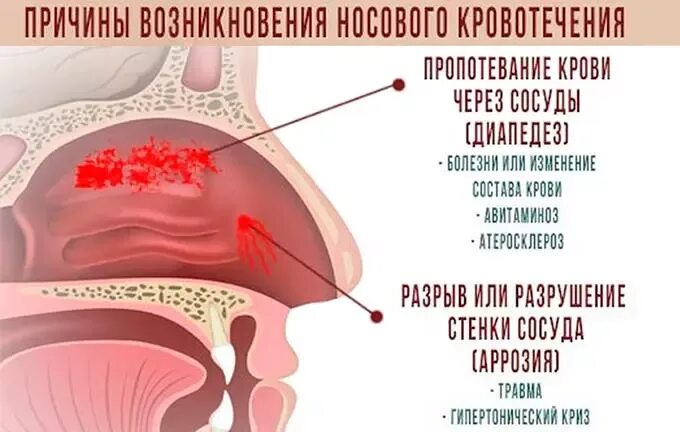 Нососове кровотечение. Насморк из носа течет вода. Аллергический ринит слизистая носа. Полоскание носа. Течет вода из носа причины.
