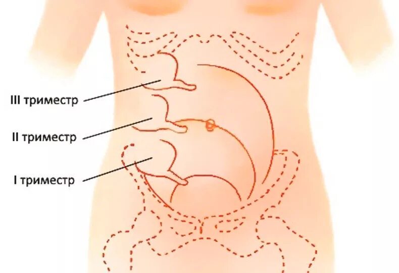 Расположение аппендикса при беременности. Аппендицит при беременности 3 триместр. Расположения червеобразного отростка при беременности. Болит аппендицит при беременности.