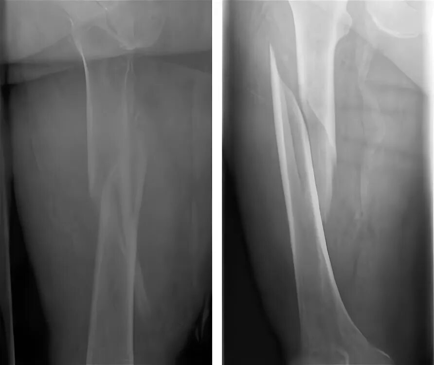 6 недель перелом. Перелом диафиза бедренной кости рентген. Винтообразный перелом бедренной кости рентген. Перелом диафиза бедра рентген. Винтообразный перелом диафиза бедренной кости.