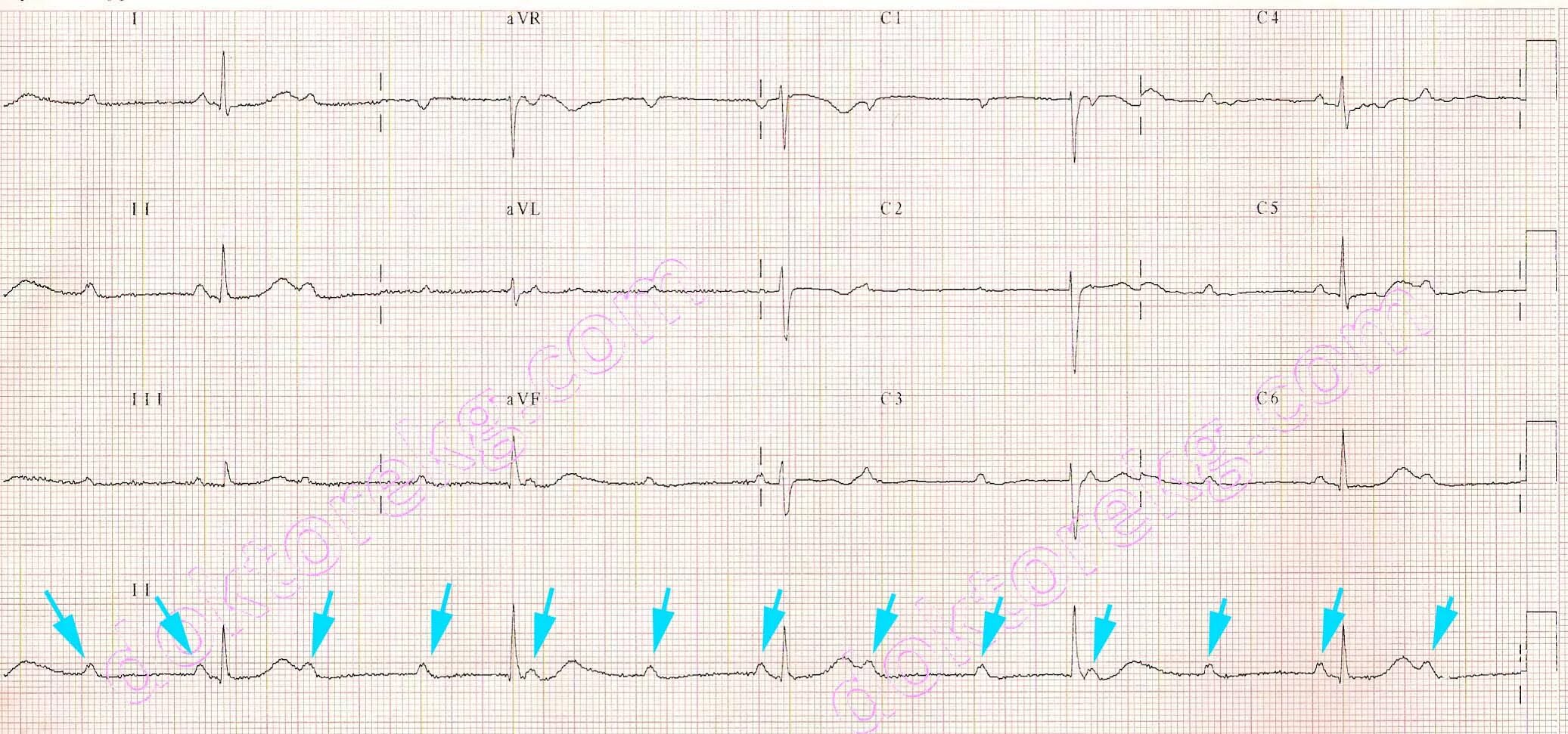 Happy graduation party! картинки. выскальзывающий ритм ав блокада. Av blocks 3 degree ecg. Complete degree. 3rd degree equation.
