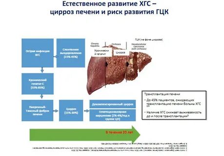 Цирроз печени причины симптомы