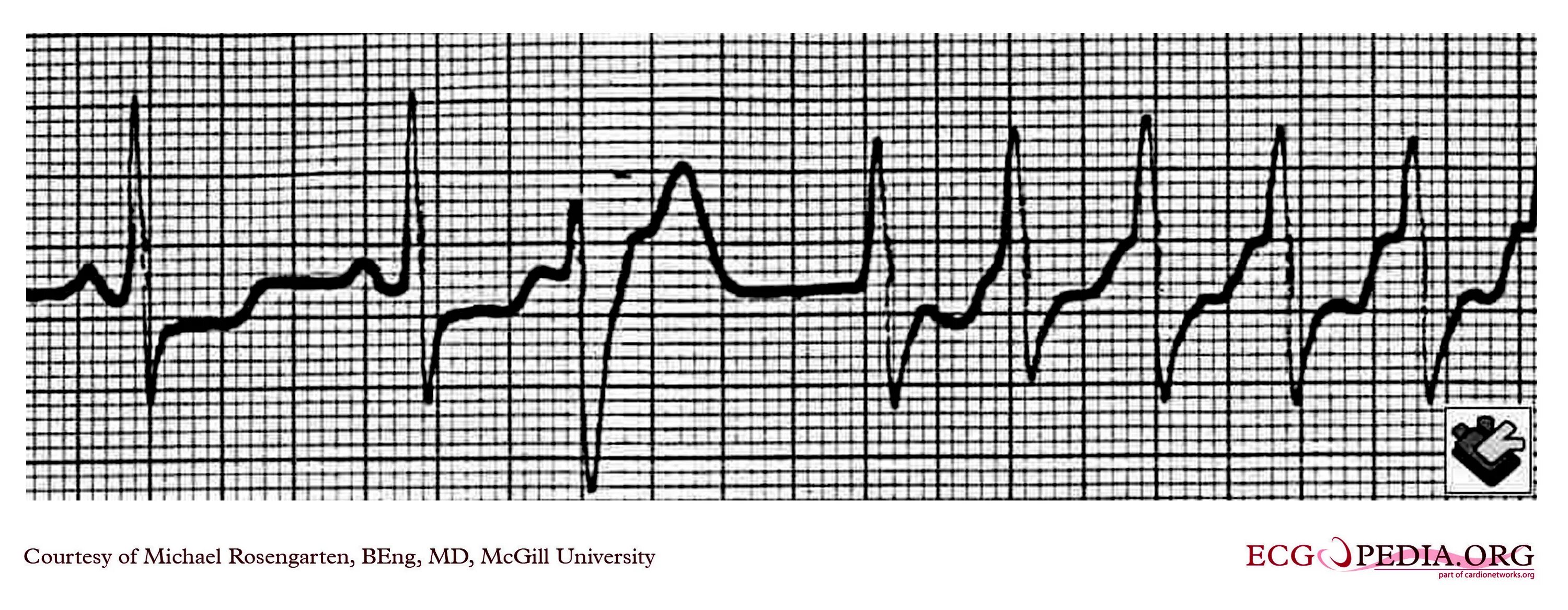 Политопные экстрасистолы. Политопная желудочковая экстрасистолия. Экг монотопные желудочковые экстрасистолы. Политопные экстрасистолы на экг. Политопные желудочковые экстрасистолы на экг.