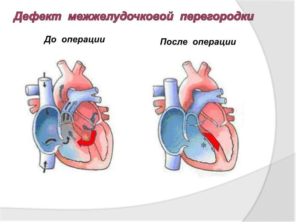 Аневризма перегородки у ребенка. Врожденный порок сердца дефект межжелудочковой перегородки. Дефект межпредсердной перегородки операция. ВПС дефект межжелудочковой перегородки. Дефект межжелудочковой перегородки патанатомия.