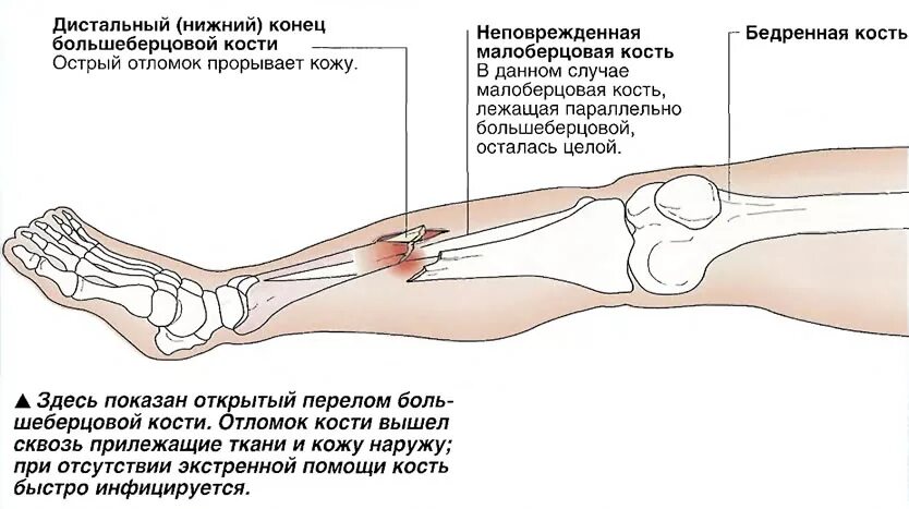 Как лечить большеберцовую кость