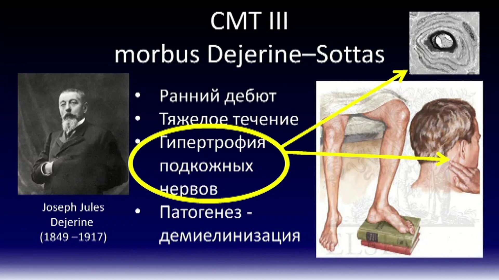 Шарко Мари Тутта полиневропатия. Невральная амиотрофия Шарко-Мари-Тутта. Мышечная дистрофия Шарко Мари. Наследственная моторно-сенсорная невропатия Шарко-Мари-тута.