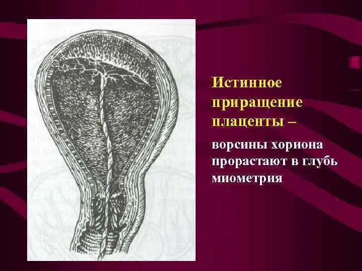 Аномалии врастания плаценты. Истинное приращение плаценты. Истинное прикрепление плаценты. Врастание плаценты в матку. Плацента на рубце матки