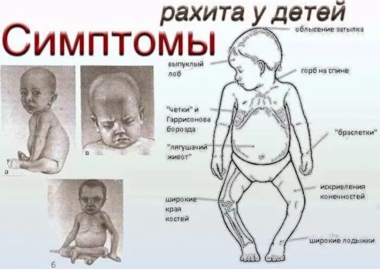 Рахит у новорожденных что это