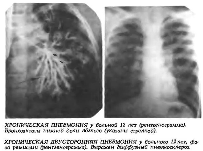 Пневмания легких лечится. Хроническая пневмония рентген. Обструктивная двусторонняя пневмония. Двухсторонняя пневмония рентген. Рентген легких пневмония двухсторонняя.