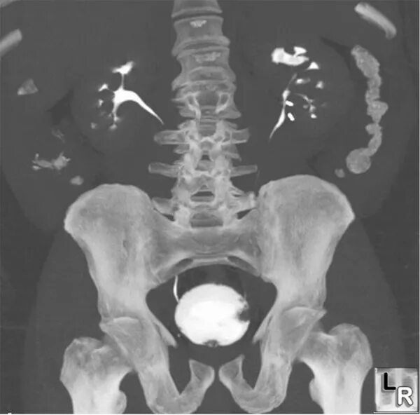 коксартроз тазобедренного сустава мкб. остеосаркома костей таза кт. остеосаркома костей таза рентген. мрт малого таза опухоли яичников. мрт омт малого таза.