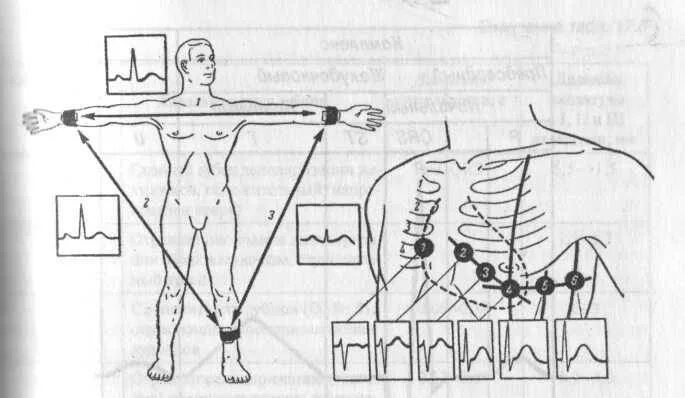 Техника наложения электродов для снятия ЭКГ. ЭКГ методика наложения электродов. Электроды ЭКГ схема наложения. Электрокардиограф (техника снятия. Соп экг