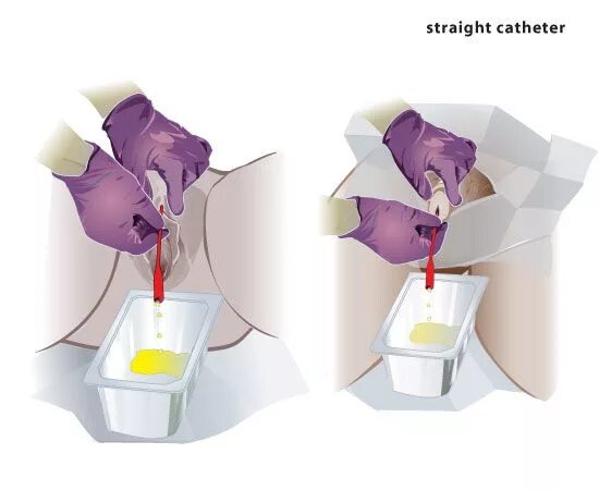 Катетер бартолиновой. Катетер для подготовки шейки матки. Катетер для спускания мочи. Катетер для расширения матки.