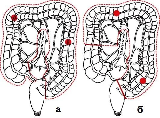 Субтотальная резекция толстой кишки. Субтотальная колэктомия операция. Субтотальная гемиколэктомия. Колэктомия это