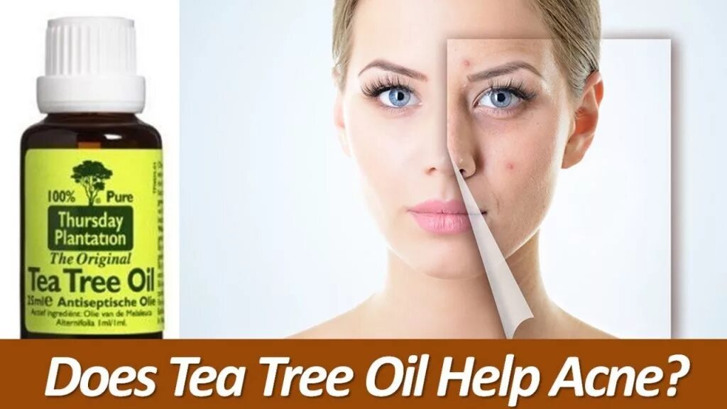 Масло чайного дерева от прыщей на лице. Oil for acne. чайное дерево от прыщей. средства от прыщей с маслом чайного дерева. реклама средства от прыщей.