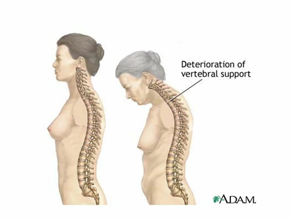 шейный лордоз и кифоз. лордоз позвоночника сглажен. искривление позвоночника лордоз. лордоз грудного отдела позвоночника. шейный лордоз сглажен.