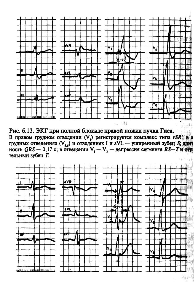 Гиса блокада пнпг. Блокада правой ножки пучка г Исса на ЭКГ. Кардиограмма блокада правой ножки пучка Гиса на ЭКГ. ЭКГ признаки полной и неполной блокады правой ножки пучка Гиса. Неполная блокада правой и левой ножки пучка Гиса на ЭКГ.