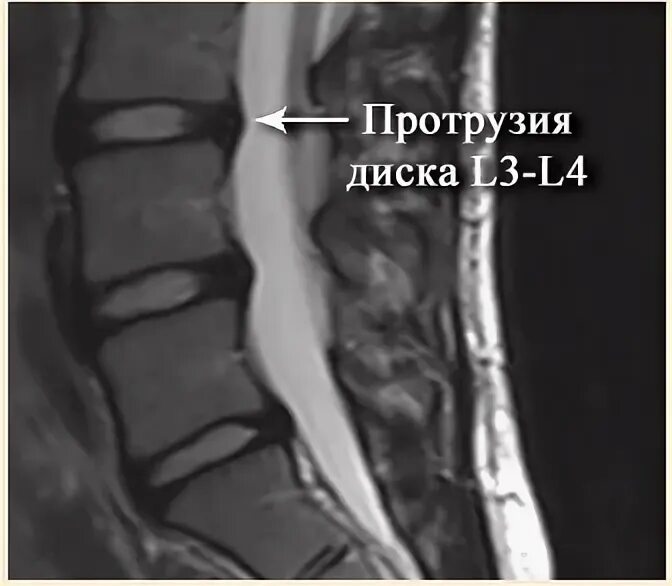 Протрузия l3-l4. Дорзальная протрузия диска l3/4. Дорзальная протрузия l3 l4. Протрузия l3 -s1 межпозвонковых дисков. Диффузная протрузия межпозвонковых