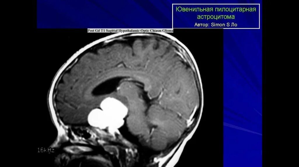 Рак ствола головного мозга. Пилоидная астроцитома мрт. Пилоцитарная астроцитома ствола. Ювенильная пилоцитарная астроцитома. Пилоидная астроцитома ствола головного мозга.