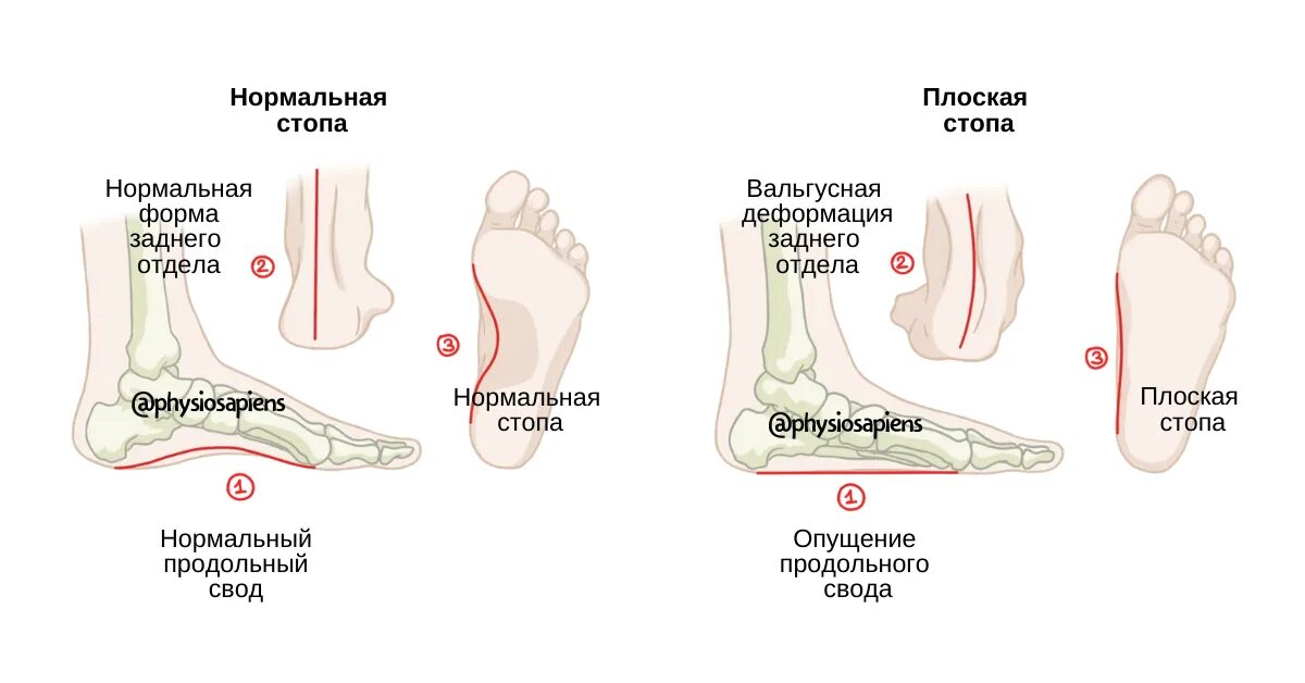 Деформация стопы. Плоскостопие поперечного свода стопы. плоско вальгусная деформация переднего отдела стопы. плоскостопие переднего свода стопы. продольное плоскостопие и вальгусная стопа.