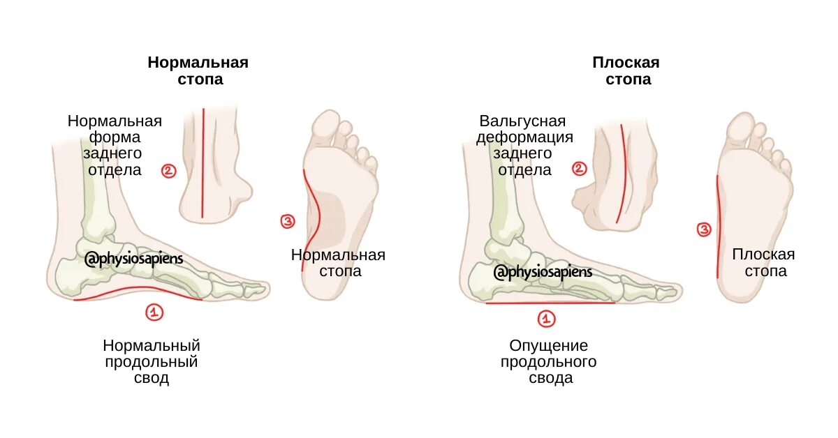 Пятки внутрь. Плоскостопие поперечного свода стопы. Продольный свод стопы плоскостопие. Плоскостопие вальгусная деформация. Продольное плоскостопие деформация стопы.