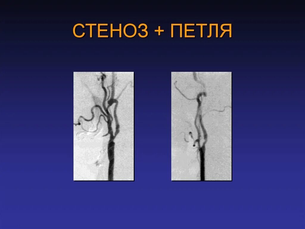 Стеноз устья вса. Стеноз типа пуговичной петли. Петля внутренней сонной артерии. Стеноз внутренней сонной артерии.