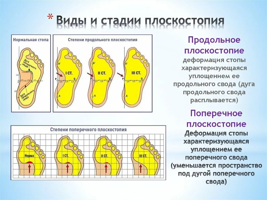 Плоскостопие у детей врач. Плоскостопие поперечный свод. Двустороннее продольно поперечное плоскостопие. Двустороннее продольное плоскостопие 2ст. Поперечным либо продольным плоскостопием 2 степени.