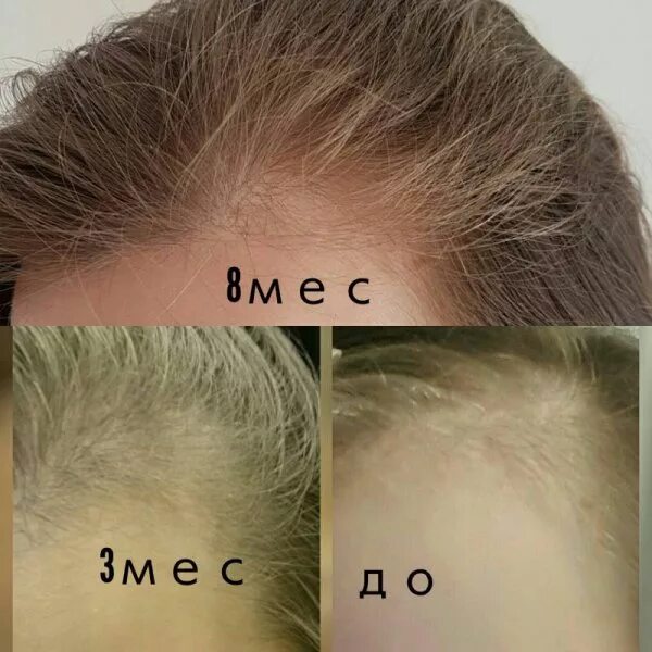 После химии выпадают. Волосы после химиотерапии. После химиотерапии волосы растут. Для роста волос. После химиотерапии выпадают волосы.