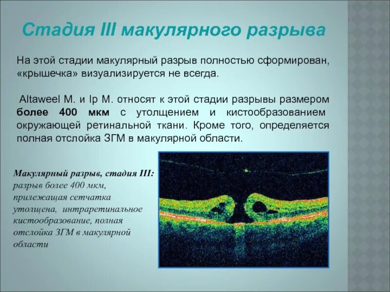 При травматическом макулярном разрыве проводится