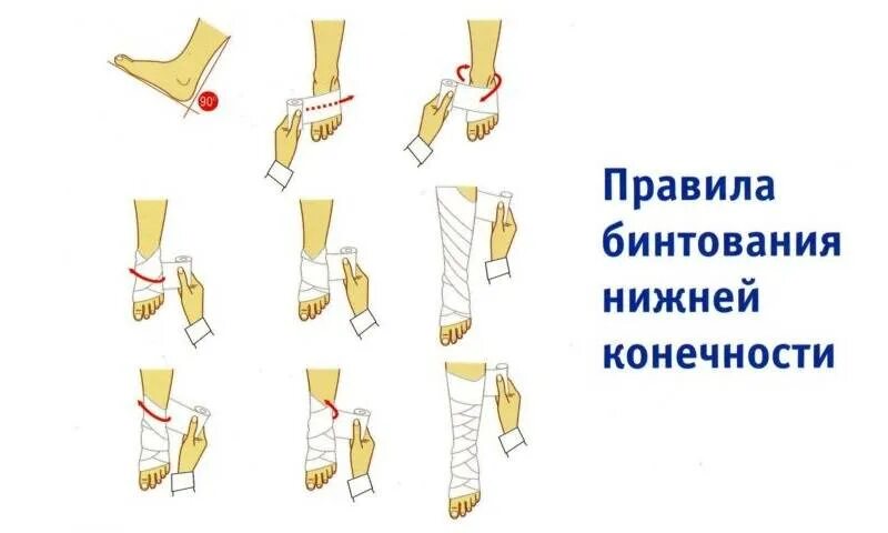 Компрессионное бинтование нижних конечностей алгоритм. Как правильно бинтовать ногу при варикозе. Накладывается эластичное бинтование бинта на нижнюю конечность. Как правильно забинтовать ногу эластичным бинтом. Техника бинтования нижних конечностей эластичным бинтом.
