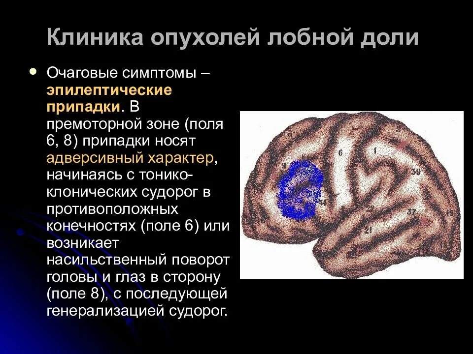 Киста лобных долей мозга. Опухоль мозга лобной доли симптомы. опухоль левой лобной доли.