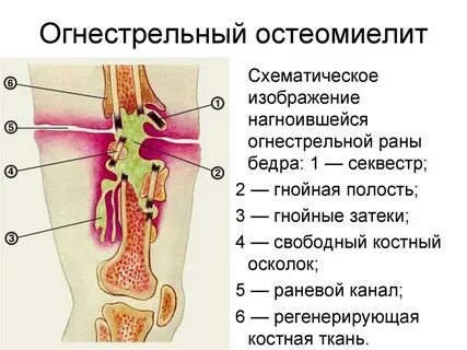 Остеомиелит кости признаки