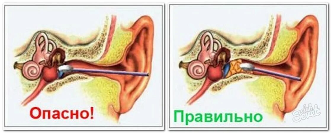 Гнойный слухи. Как выглядит ушная пробка.