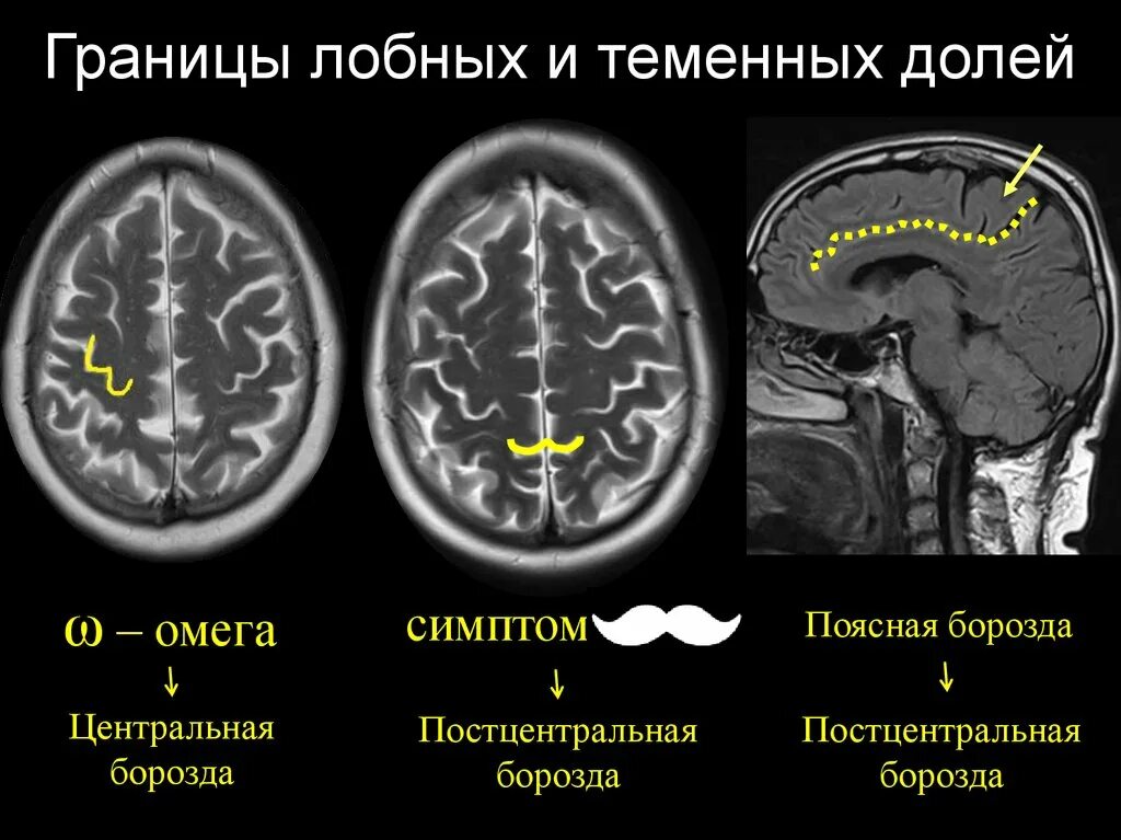 Образование в лобной доле. Граница лобной и теменной долей мрт. Граница лобной и теменной долей на кт. Извилины лобной доли кт. Границы долей головного мозга на кт.