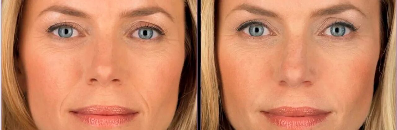 Aging filter