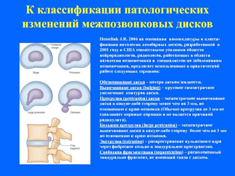 Грыжа межпозвоночного диска классификация. Грыжи дисков классификация. • Межпозвоночные диски классификация. Дискорадикулярный конфликт. Диффузное выбухание межпозвоночного