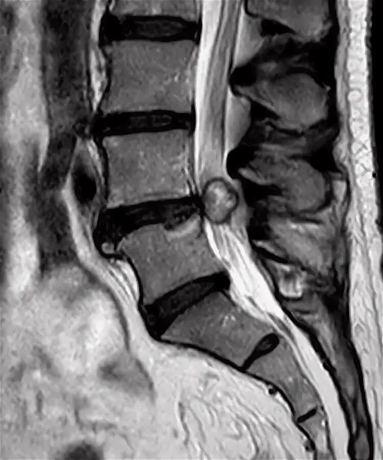 Периневральная ликворная киста. Периневральная киста позвоночника s2. Периневральная киста позвоночника s3. Периневральная киста позвоночника s3 s4. Операция кисты позвоночника