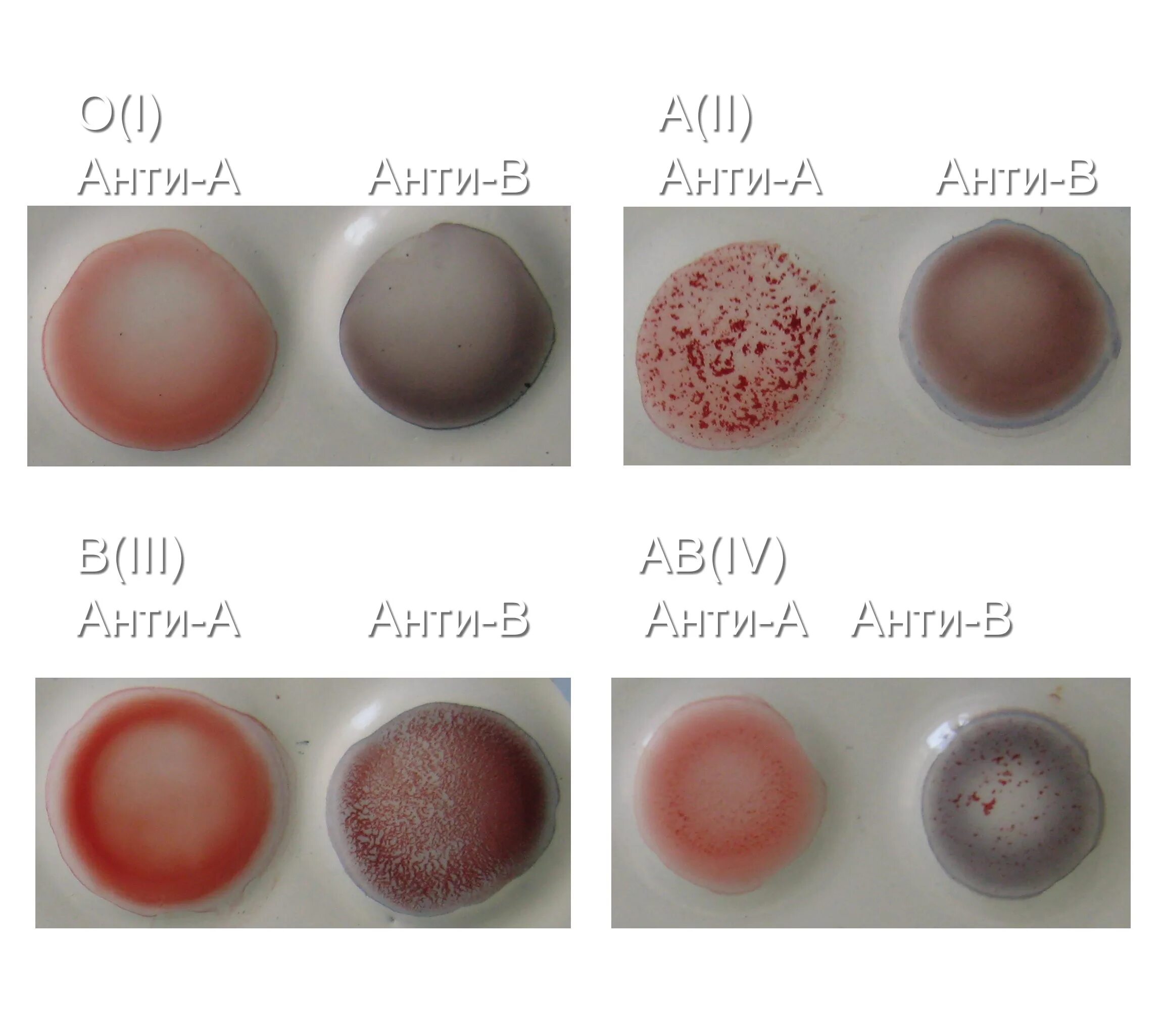 реакция агглютинации для определения группы крови. при отсутствии агглютинации с реагентами. определить резус-фактор крови цоликлонами. цоликлон для определения резус фактора. реакция агглютинации для определения резус фактора.