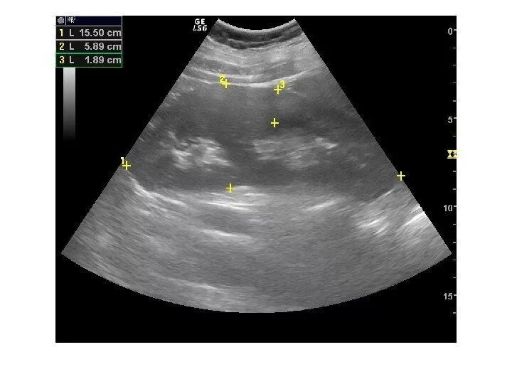 Изменение синусов обеих почек. Расширение ЧЛС почек на УЗИ. Патология почек УЗИ Изранов. Расширение ЧЛС на УЗИ. Чашечно лоханочная система на УЗИ.